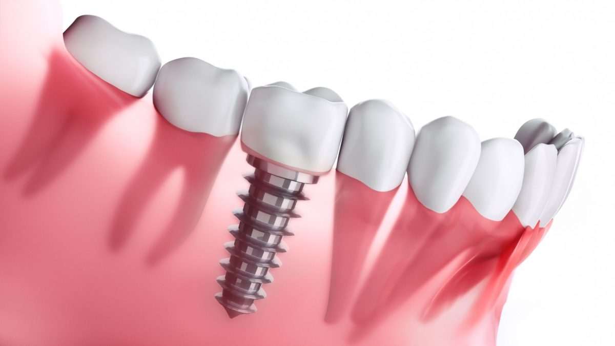 ZAŠTO ODABRATI DENTICO ZA UGRADNJU ZUBNIH IMPLANTATA?